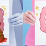 La señal al ir al baño que muchos ignoran y que podría ser una alerta de cáncer colorrectal
